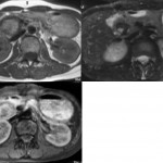 33歳女性　腹痛　MRI T1, T1FS, T2WIFS